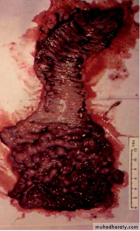 Diseases of large bowel