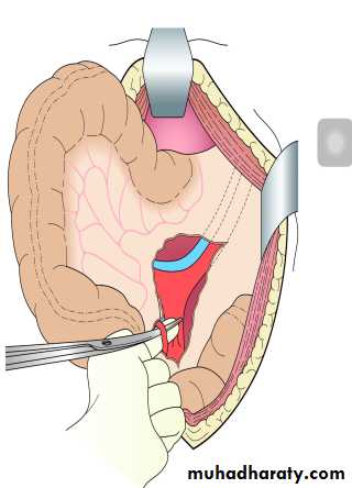 Diseases of large bowel