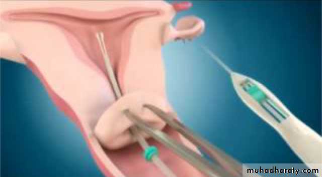 Slides of gynecology