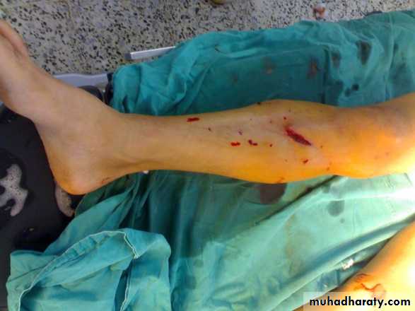 tibial and fibular injury