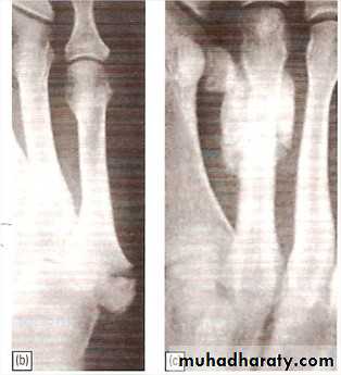 tibial and fibular injury