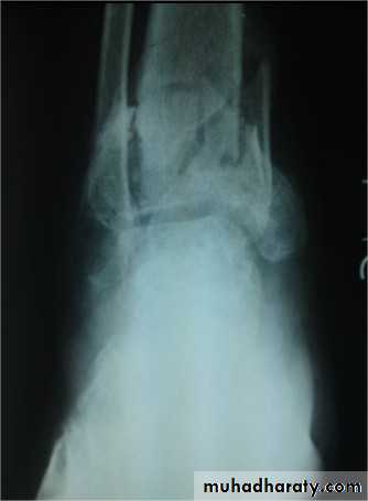 tibial and fibular injury