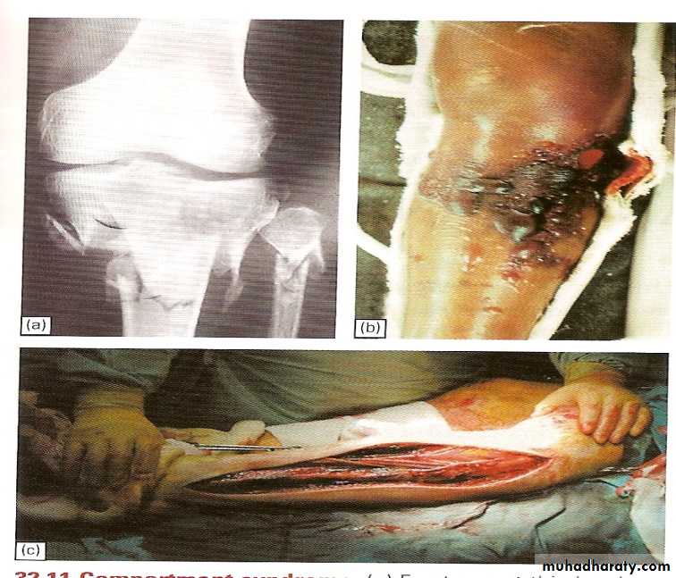 tibial and fibular injury