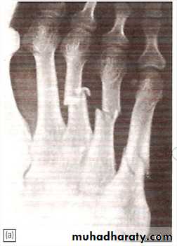 tibial and fibular injury