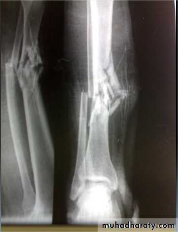 tibial and fibular injury