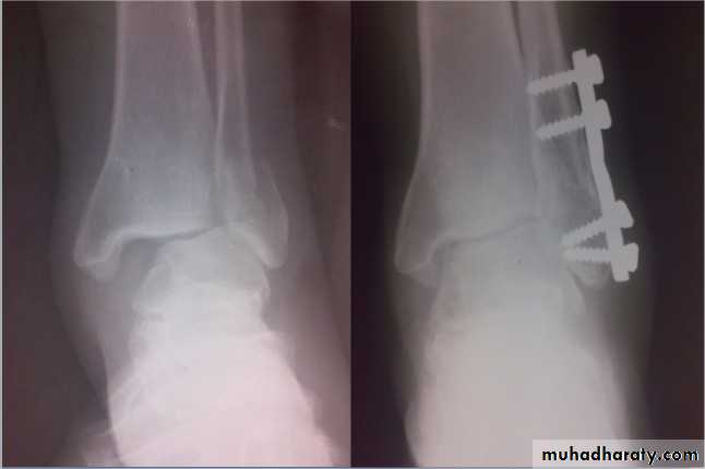 tibial and fibular injury