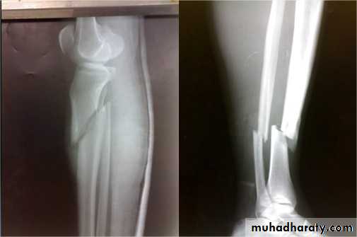 tibial and fibular injury