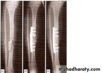 tibial and fibular injury
