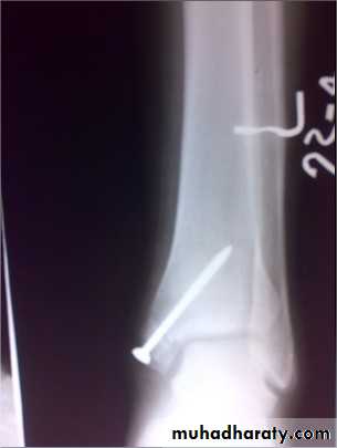 tibial and fibular injury