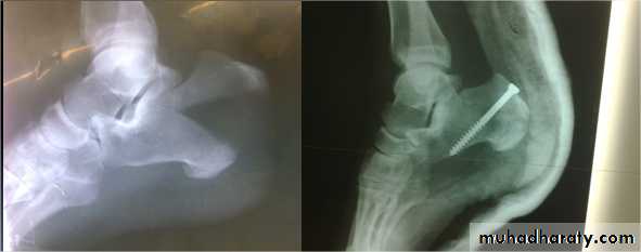 tibial and fibular injury