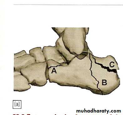 tibial and fibular injury