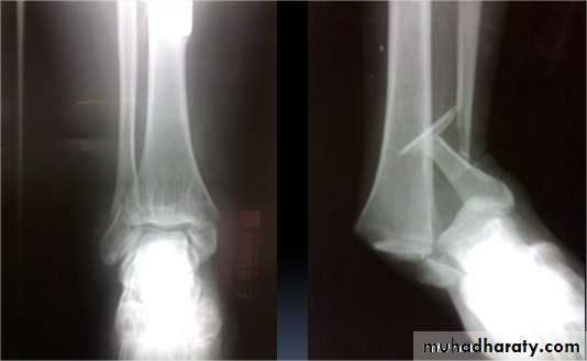tibial and fibular injury