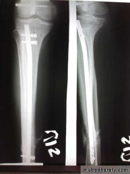 tibial and fibular injury