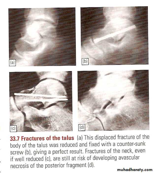 tibial and fibular injury