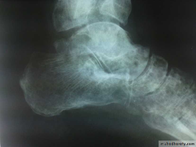 tibial and fibular injury
