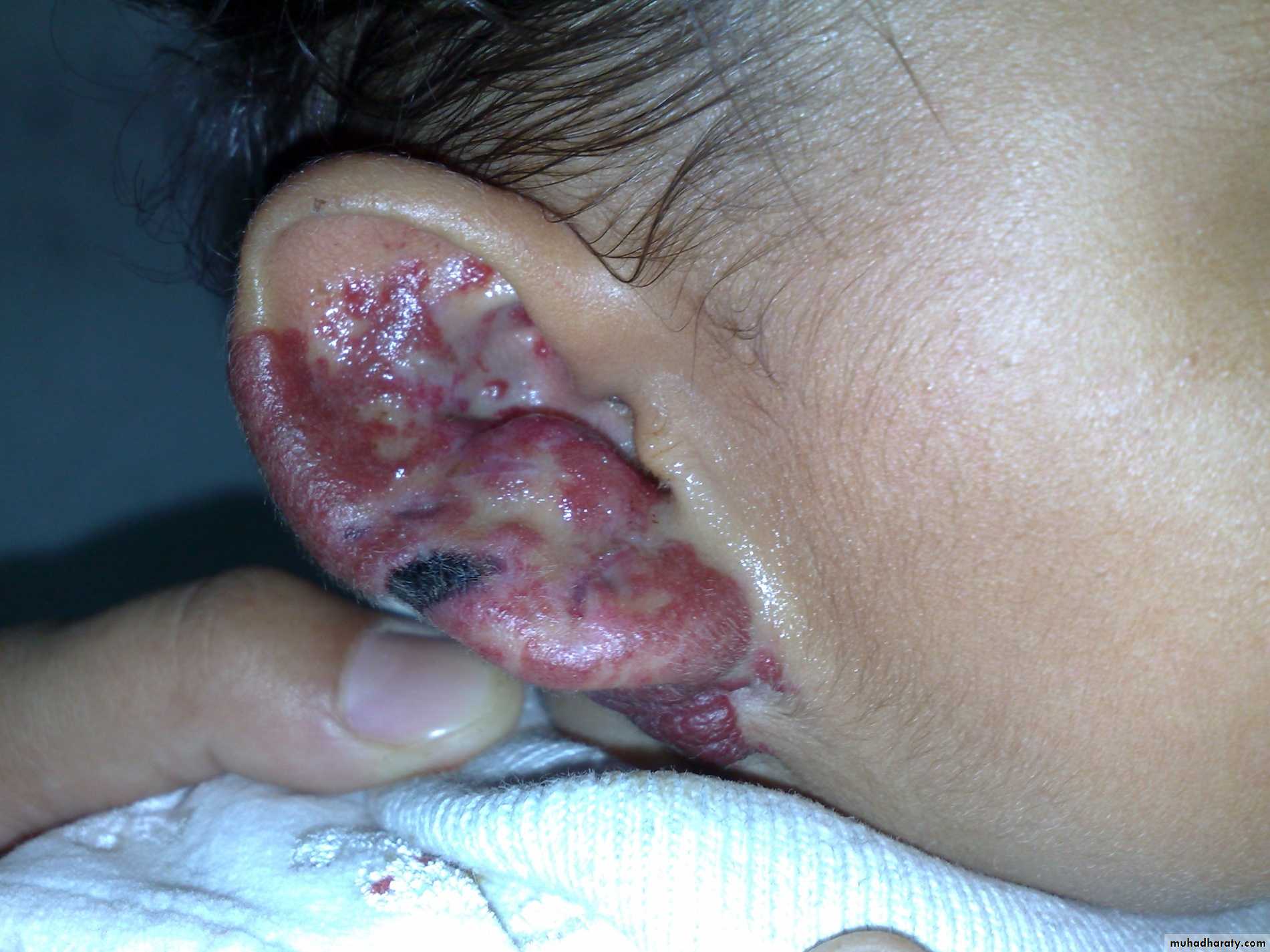 Pediatric surgery