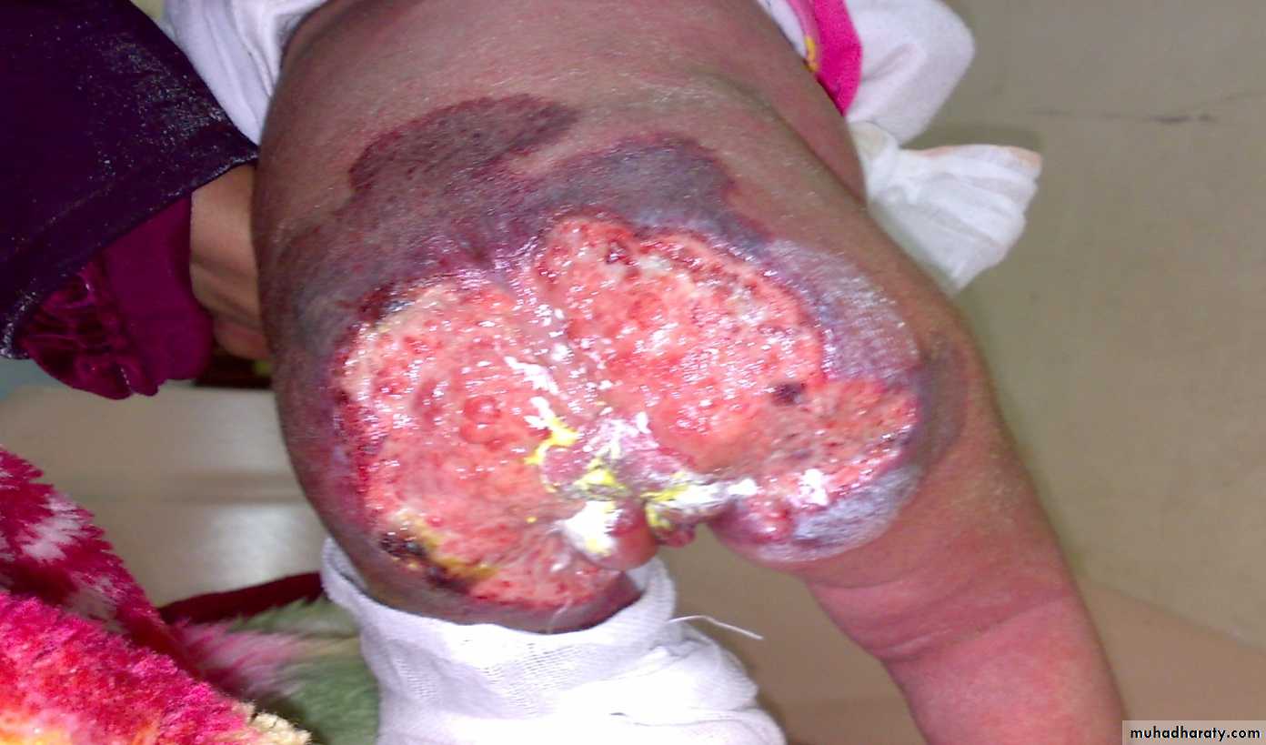 Pediatric surgery