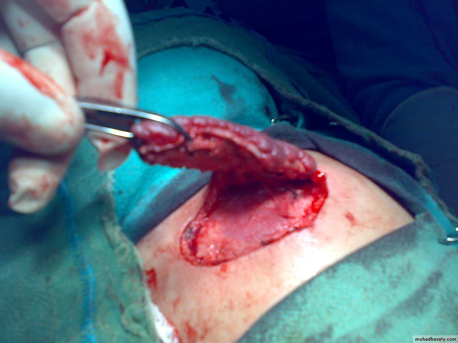 Pediatric surgery