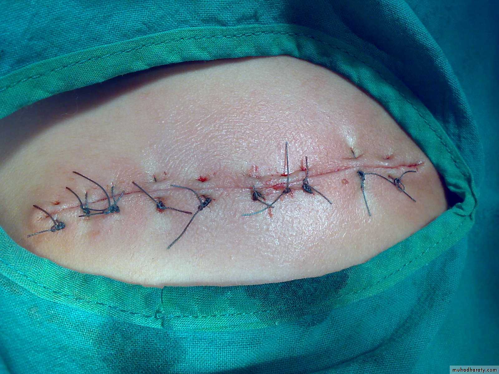 Pediatric surgery