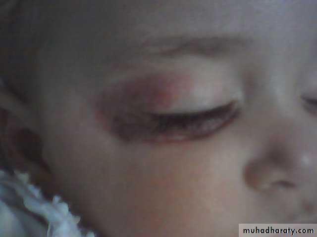 Pediatric surgery