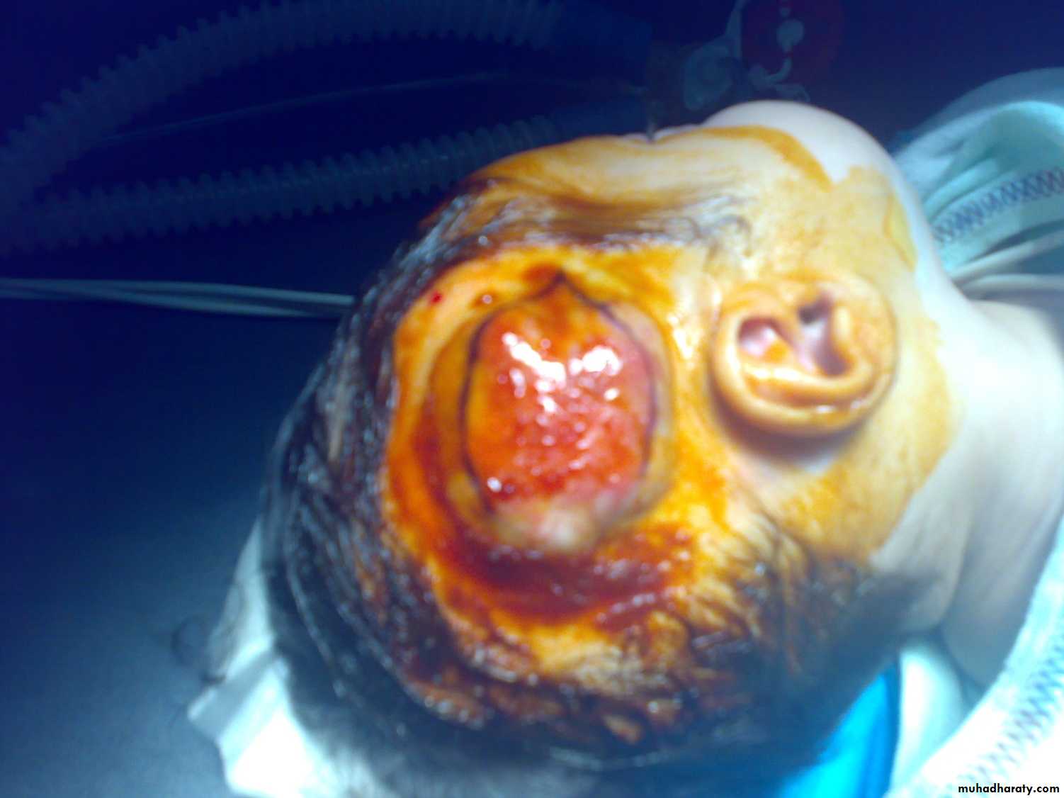 Pediatric surgery