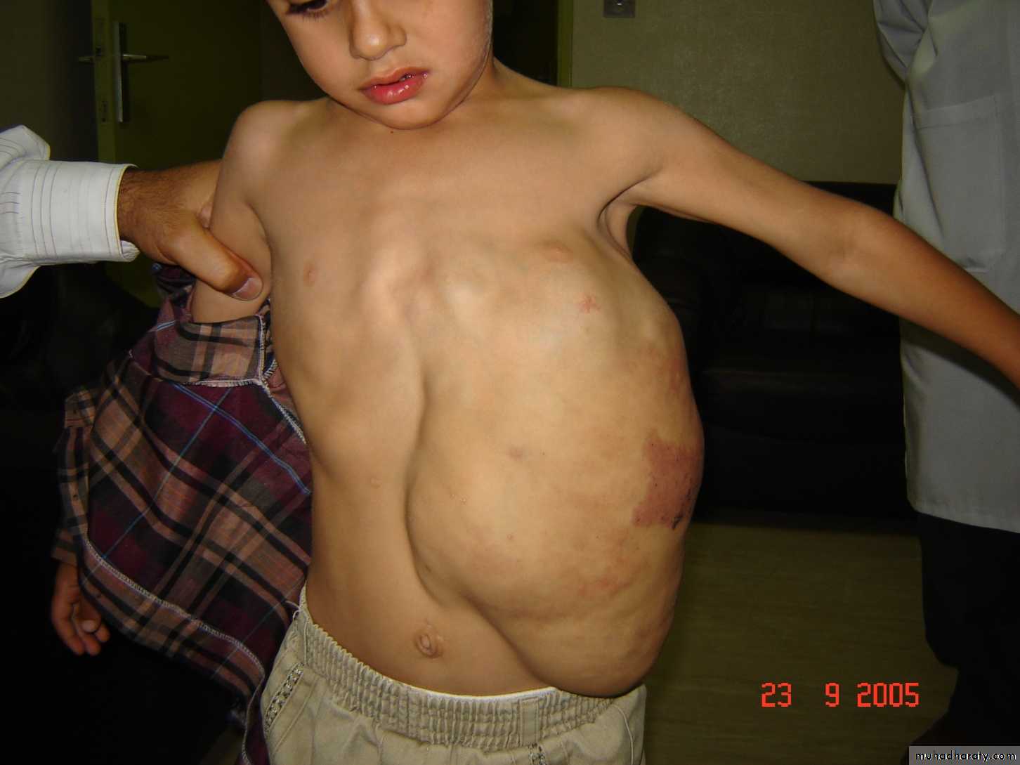 Pediatric surgery