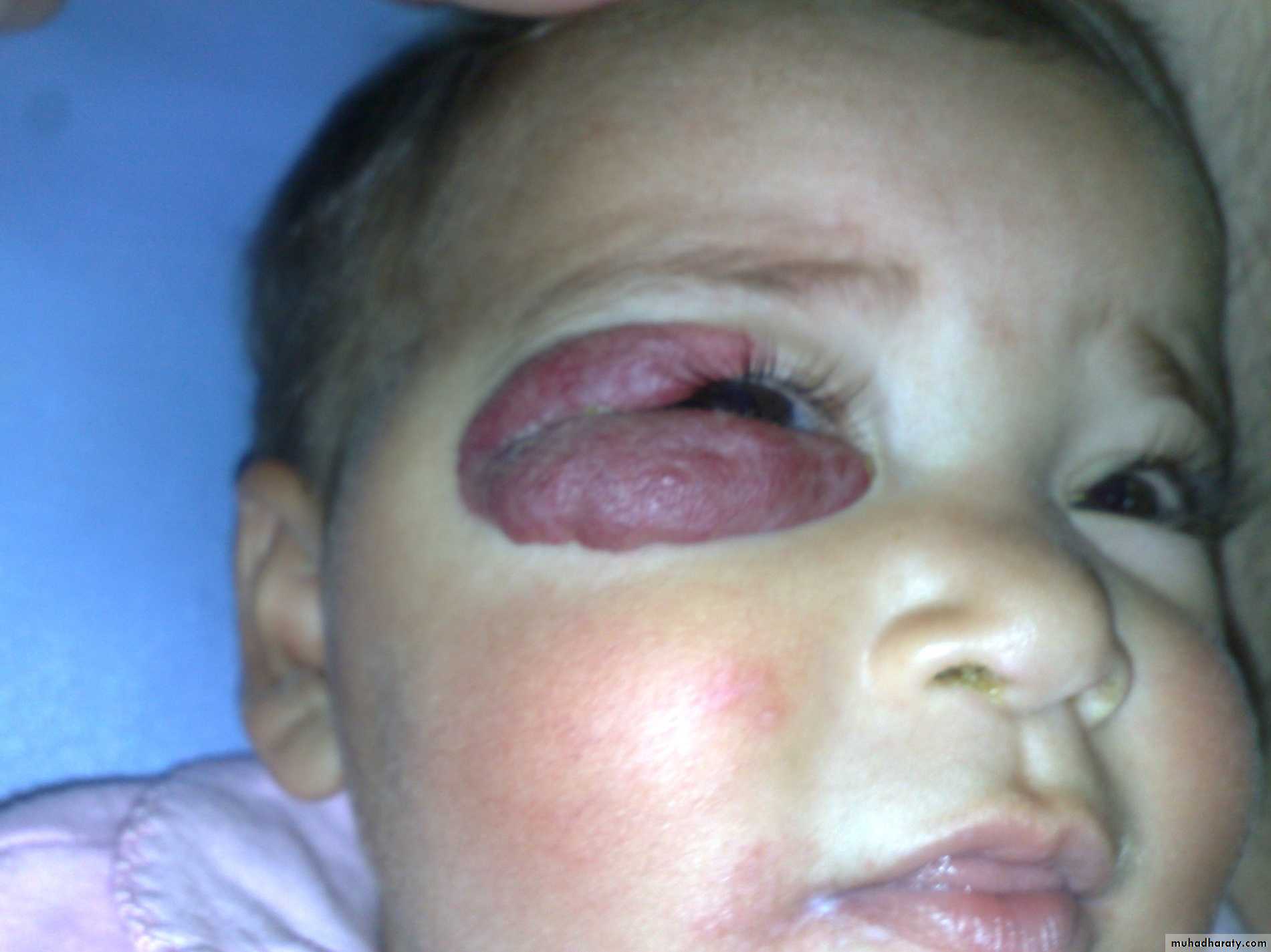 Pediatric surgery