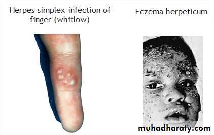 infectious disease