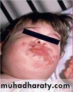 infectious disease