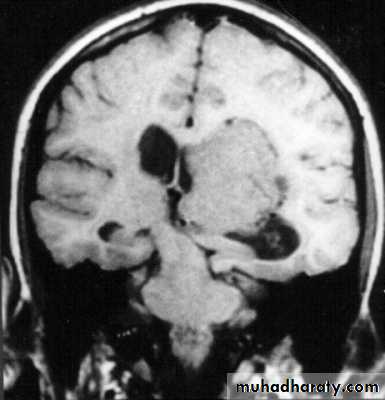 Neurosurgery
