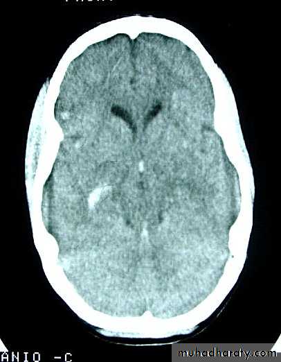 Neurosurgery