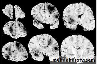 Neurosurgery