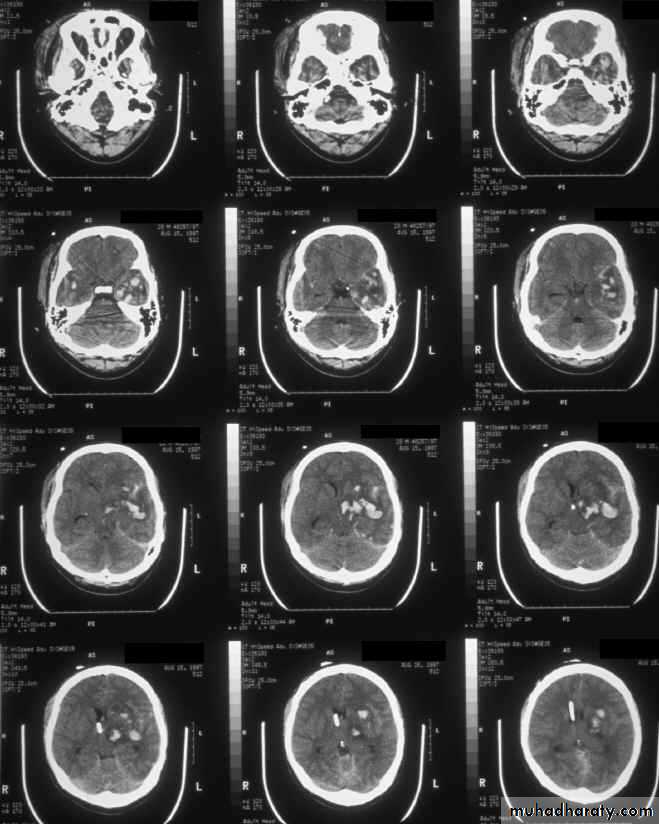 Neurosurgery