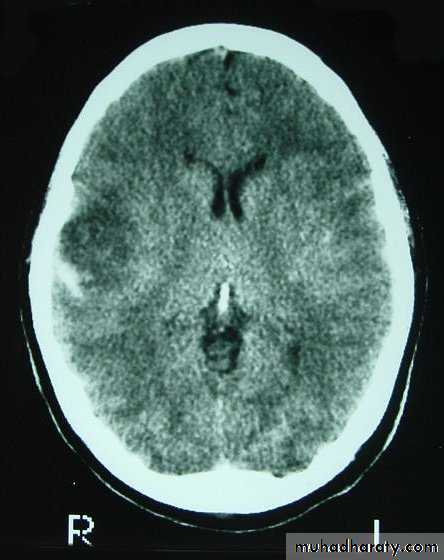 Neurosurgery
