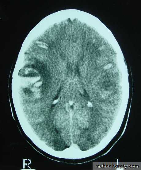 Neurosurgery