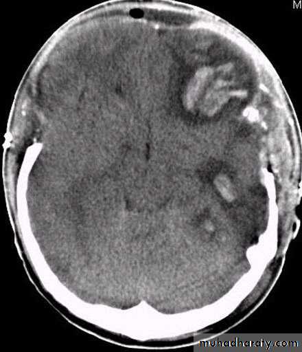 Neurosurgery