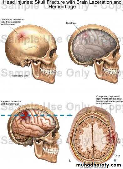 Neurosurgery