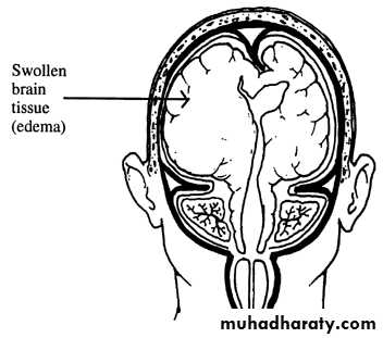 Neurosurgery
