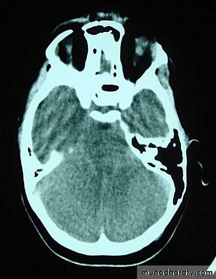 Neurosurgery