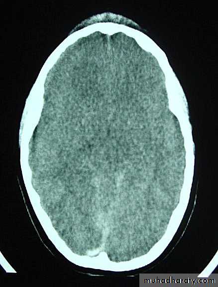 Neurosurgery