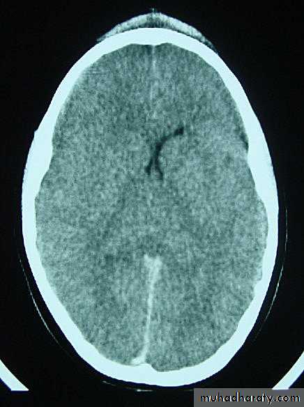 Neurosurgery