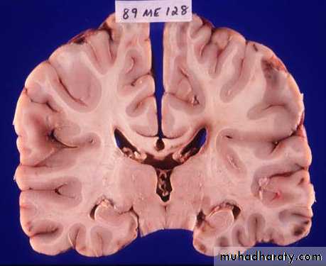 Neurosurgery