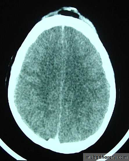 Neurosurgery