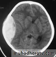 Neurosurgery