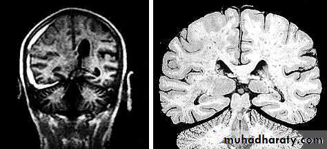 Neurosurgery
