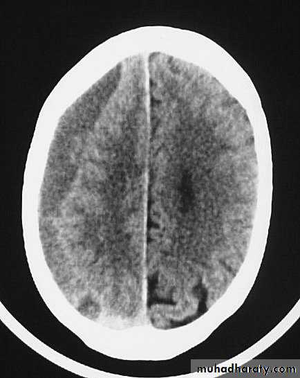Neurosurgery