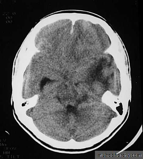 Neurosurgery