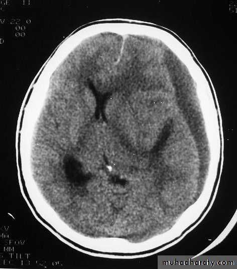 Neurosurgery