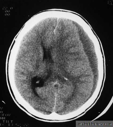 Neurosurgery