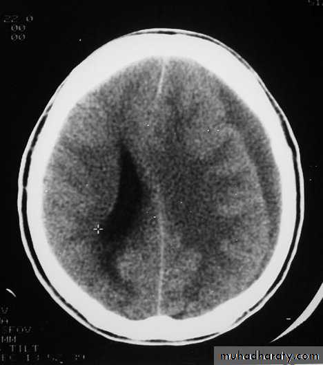 Neurosurgery